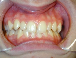 Έντονος συνωστισμός σε επάνω και κάτω οδοντικό τόξο
